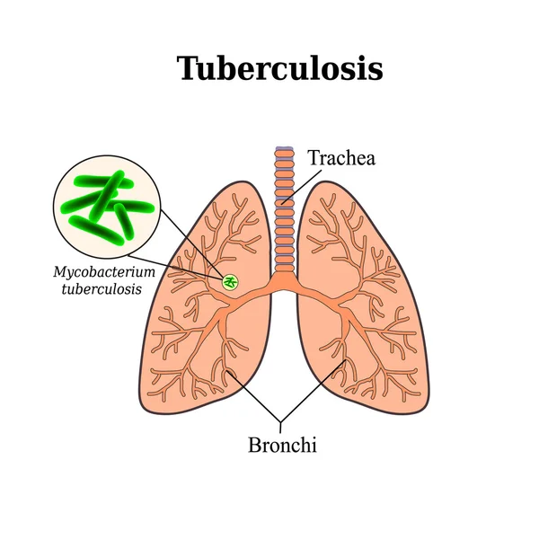 Tuberculosis. Enfermedad pulmonar. Bacilo tubérculo. Ilustración vectorial sobre fondo aislado — Vector de stock