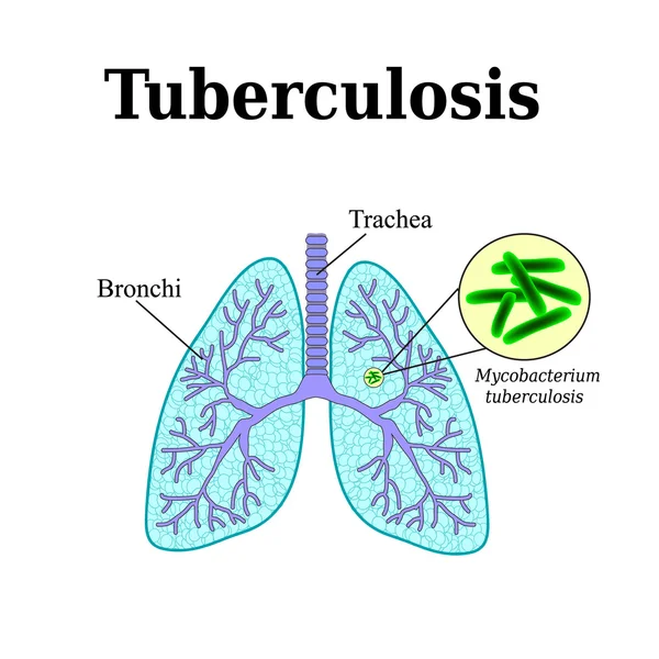 Tuberculosis. Enfermedad pulmonar. Bacilo tubérculo. Ilustración vectorial — Vector de stock