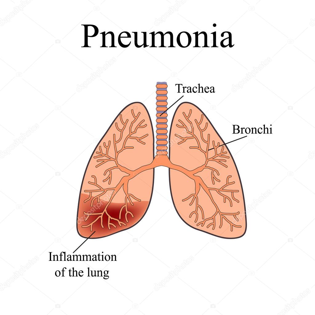 Pneumonia. The anatomical structure of the human lung. Vector illustration on isolated background