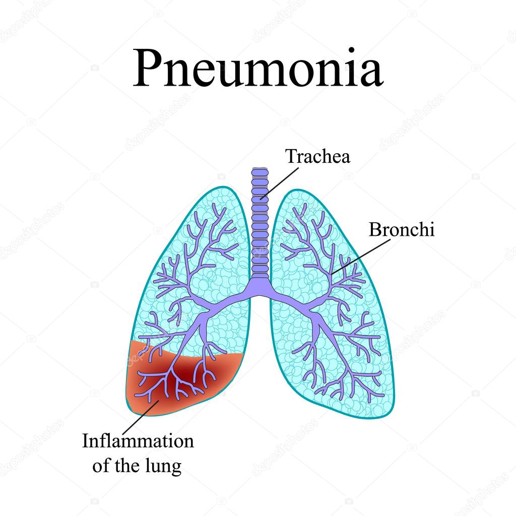 Pneumonia. The anatomical structure of the human lung. Vector illustration on isolated background
