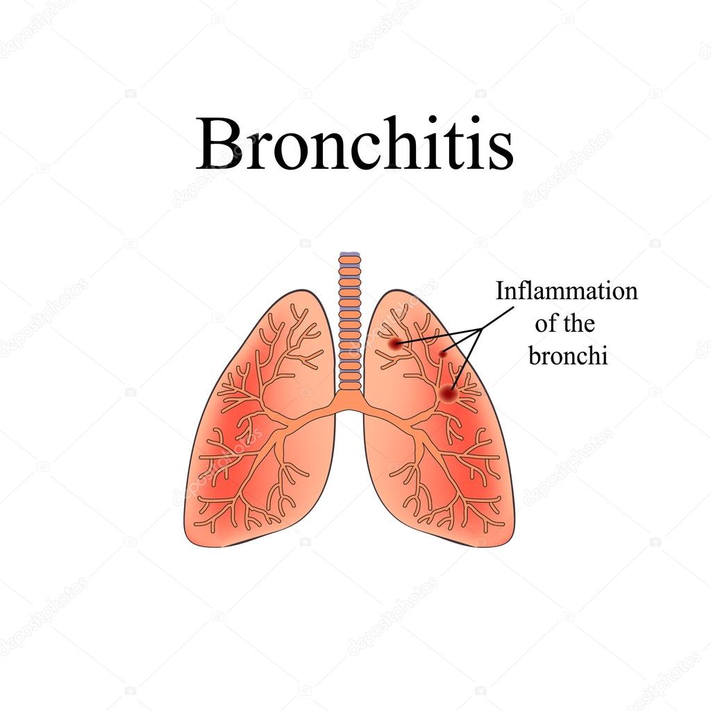 Bronchitis. The anatomical structure of the human lung. Vector illustration on isolated background