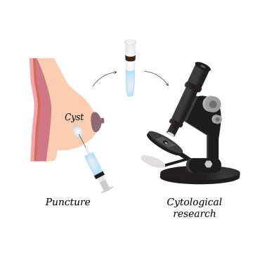 Puncture of cysts in the breast. Cytological analysis. Biopsy. Histological examination. Infographics. Vector illustration clipart