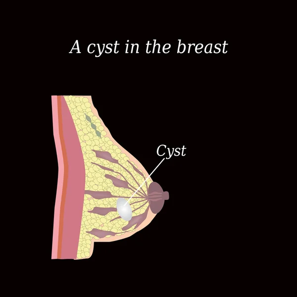 Een cyste in de borst. De structuur van de borst. Mammary gland — Stockvector