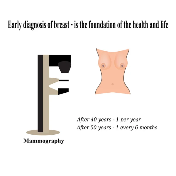 Mamografía. Diagnóstico de cáncer de mama. Diagnóstico de quistes en la mama — Vector de stock