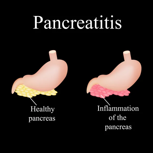 Inflamación del páncreas. Pancreatitis. La enfermedad del páncreas. Ilustración vectorial sobre fondo negro — Vector de stock