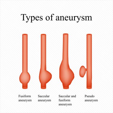 Anevrizma. Türleri anevrizma. Infographics. Vektör çizim