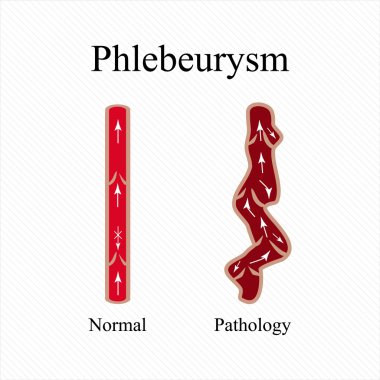 Phlebeurysm. Varisli damarlar. Venöz hastalığı. Infographics. Vektör çizim