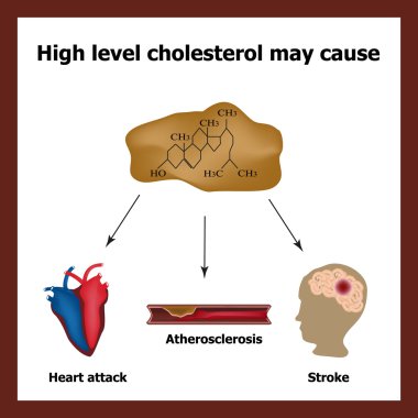 High cholesterol causes - heart attack, stroke, atherosclerosis. Chemical formula cholesterol. Cholesterol plaques. Infographics. Vector illustration clipart
