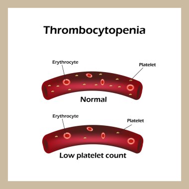 Trombositopeni. Thrombocytes kandaki düşük düzeyde. Infographics. Vektör çizim