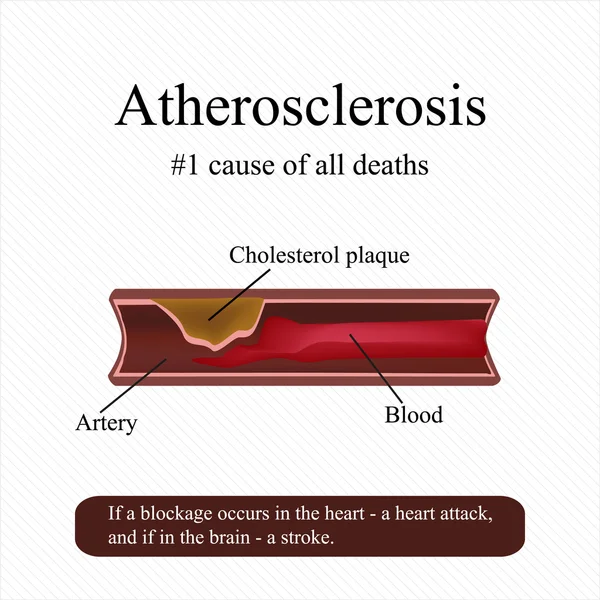 Aterosclerosis. Colesterol alto en la sangre. Bloqueo de una arteria. Ilustración vectorial — Vector de stock