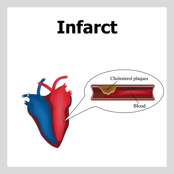 Kalp krizi. Ateroskleroz. Trombus olgusu. Kolesterol damar tıkanma. Kolesterol plaklar. Infographics. Vektör çizim — Stok Vektör