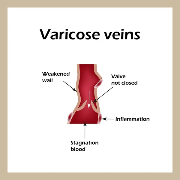 Flebeurisma. Vene varicose. Malattia venosa. Infografica. Illustrazione vettoriale — Vettoriale Stock