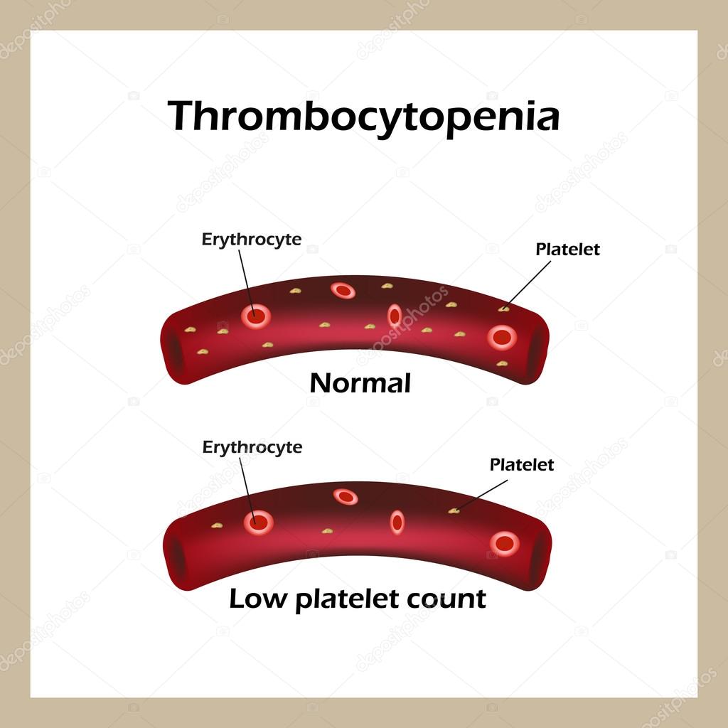 Thrombocytopenia. Reduced levels of thrombocytes in the blood. Infographics. Vector illustration