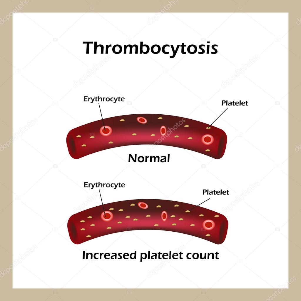 Thrombocytosis. Elevated levels of blood platelets. Infographics. Vector illustration
