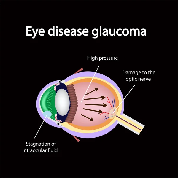 Glaucomatous oog. Schendingen veroorzaakt glaucoom — Stockvector
