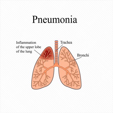 Zatürree. İnsan akciğer anatomik yapısı. Akciğer üst LOB enflamasyonu. Vektör çizim