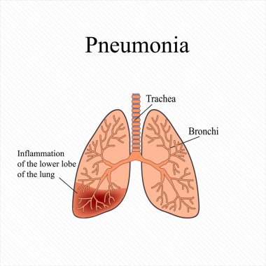 Zatürree. İnsan akciğer anatomik yapısı. Akciğer alt LOB enflamasyonu. Vektör çizim