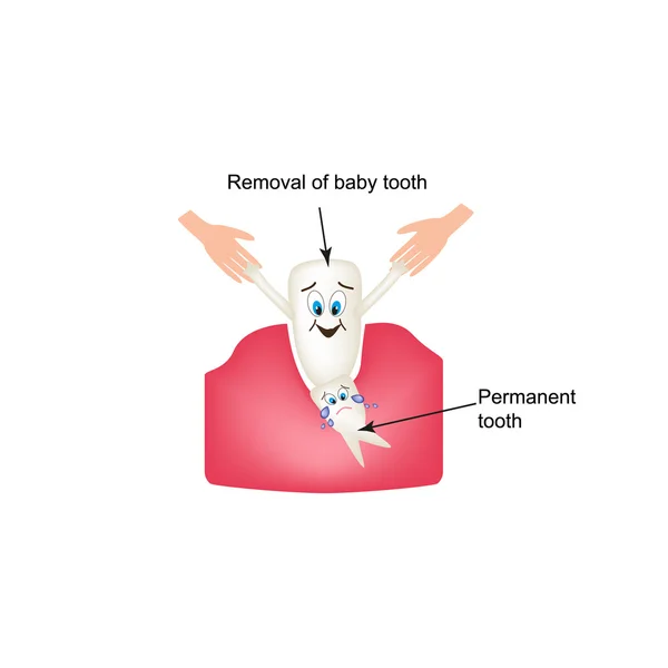 Rimozione di denti da latte. Stile cartone animato per bambini. Infografica. Illustrazione vettoriale su sfondo isolato — Vettoriale Stock