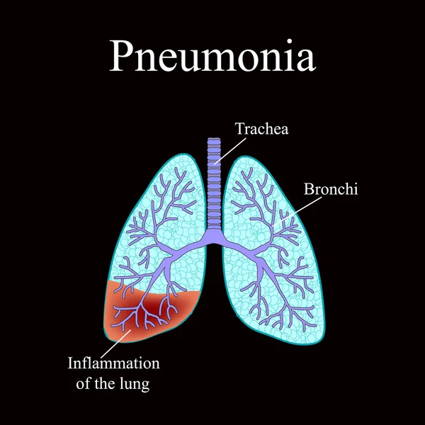 Pneumonia. A estrutura anatômica do pulmão humano. Ilustração vetorial sobre fundo preto — Vetor de Stock