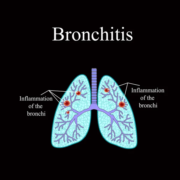 Bronquitis. La estructura anatómica del pulmón humano. Ilustración vectorial sobre fondo negro — Vector de stock