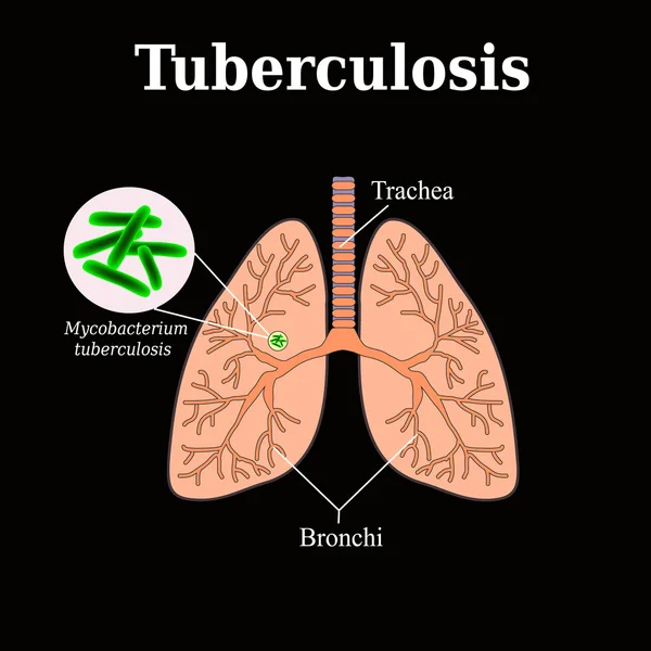 Tuberkuloosi. Keuhkosairaus. Tubercle bacillus. Vektorin kuvitus mustalla taustalla — vektorikuva