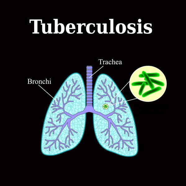 Туберкулез. Заболевание легких. Туберкулез бациллы. Векторная иллюстрация на черном фоне — стоковый вектор