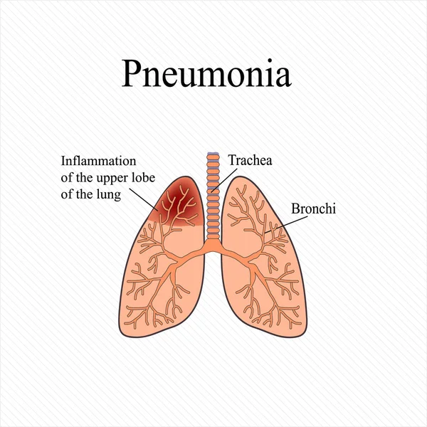 Neumonía. La estructura anatómica del pulmón humano. Inflamación del lóbulo superior del pulmón. Ilustración vectorial — Vector de stock