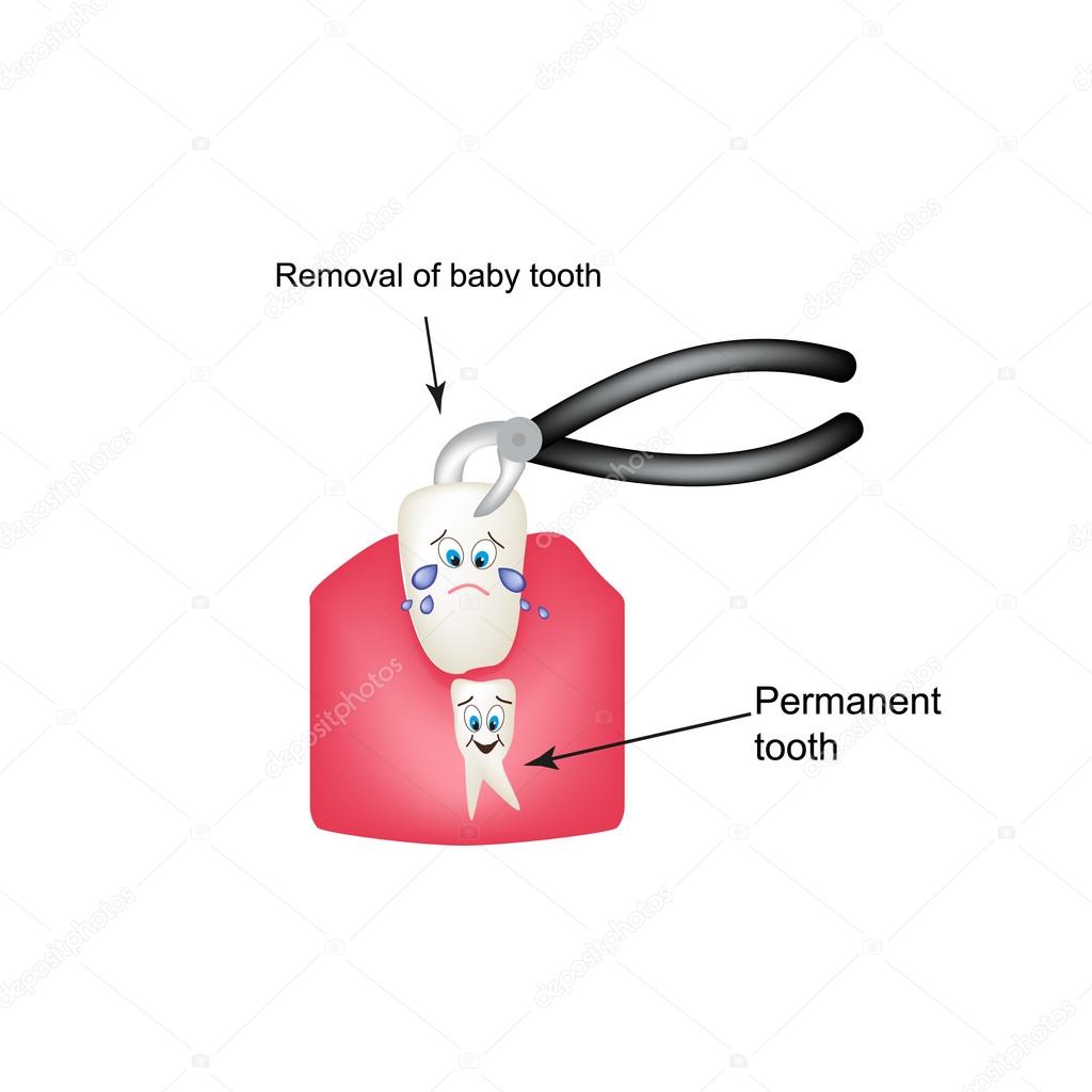 Removing baby teeth ticks. Childrens cartoon style. Infographics. Vector illustration on isolated background