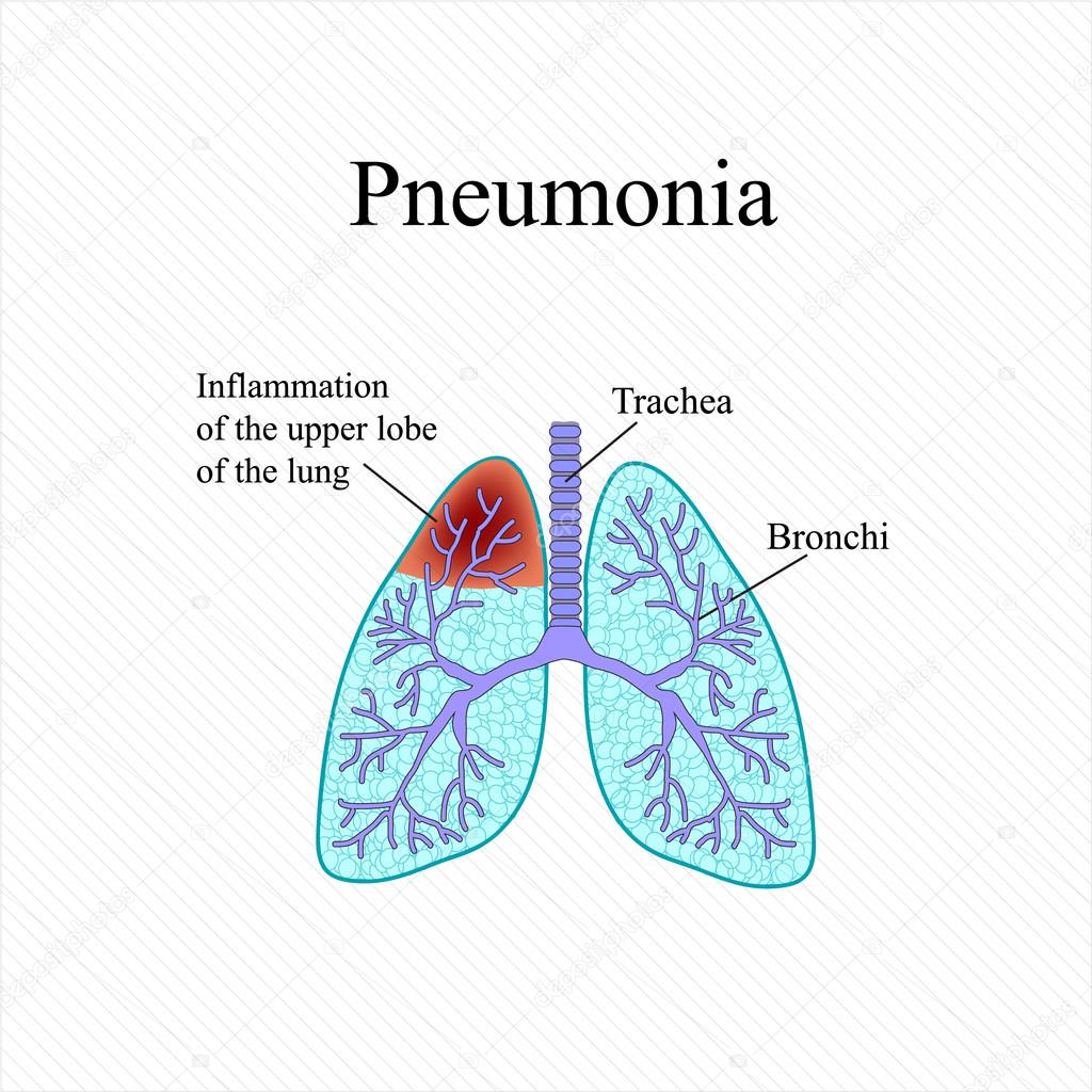 Pneumonia. The anatomical structure of the human lung. Inflammation of the upper lobe of the lung. Vector illustration