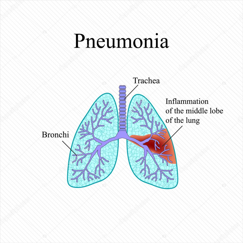 Pneumonia. The anatomical structure of the human lung. Inflammation of the middle lobe of the lung. Vector illustration