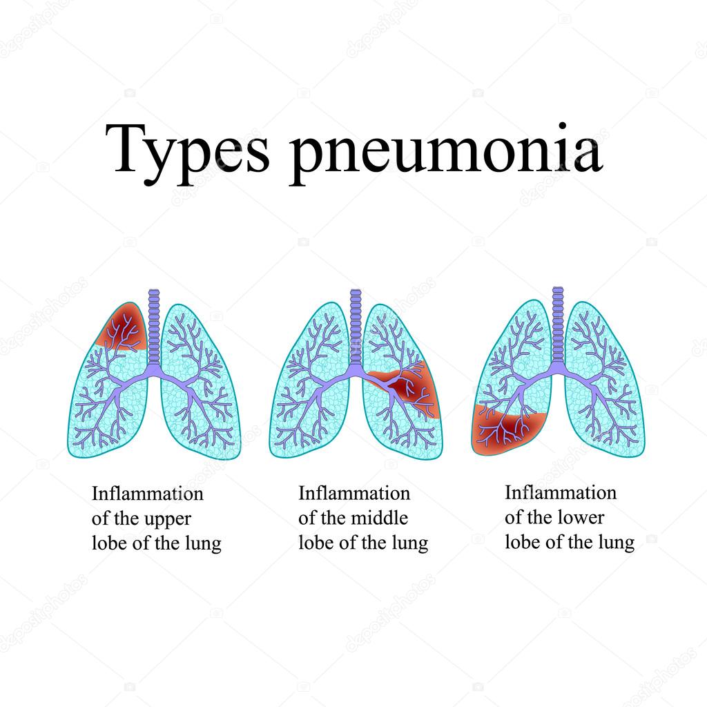 Pneumonia. The anatomical structure of the human lung. Type of pneumonia.  Vector illustration on isolated background