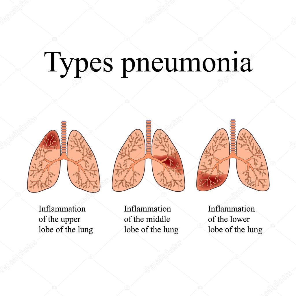 Pneumonia. The anatomical structure of the human lung. Type of pneumonia.  Vector illustration on isolated background