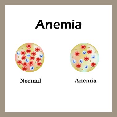 Anemi var. Alyuvar sayısı azaldı. Bilgi grafikleri. Vektör illüstrasyonu