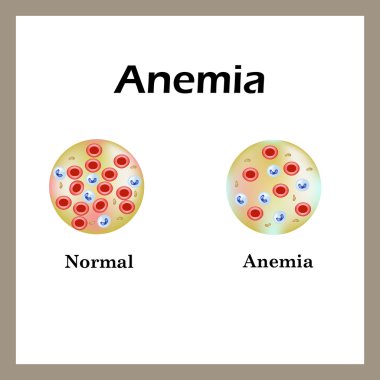 Anemia. The reduced amount of red blood cells. Infographics. Vector illustration clipart