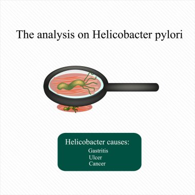 Helicobacter pylori analiz. Infographics. Vektör çizim