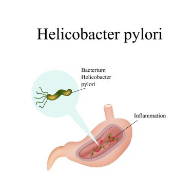 Helicobacter pylori midede. Infographics. Vektör çizim