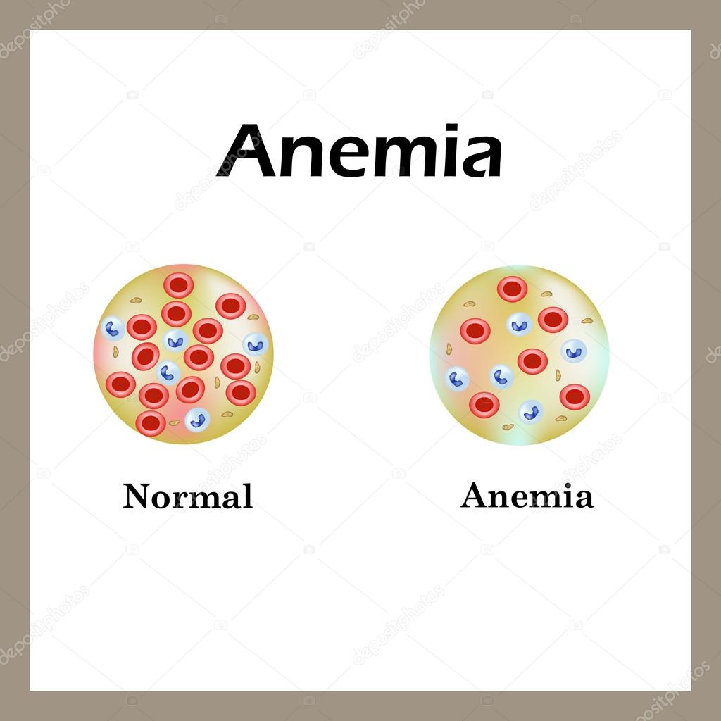 Anemia. The reduced amount of red blood cells. Infographics. Vector illustration