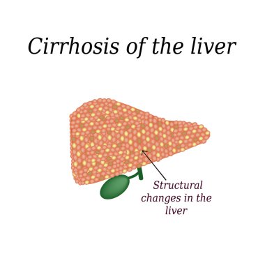 Cirrhosis of the liver. Vector illustration on isolated background clipart