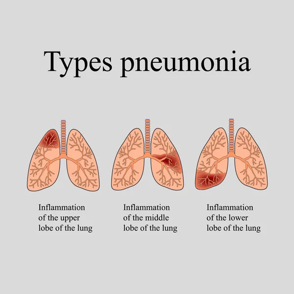 Zapalenie płuc. Anatomiczne struktury ludzkiego płuca. Typ zapalenia płuc. Ilustracja wektorowa na szarym tle — Wektor stockowy