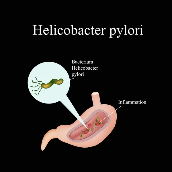 Helicobacter pylori w żołądku. Infografiki. Ilustracja wektorowa — Wektor stockowy