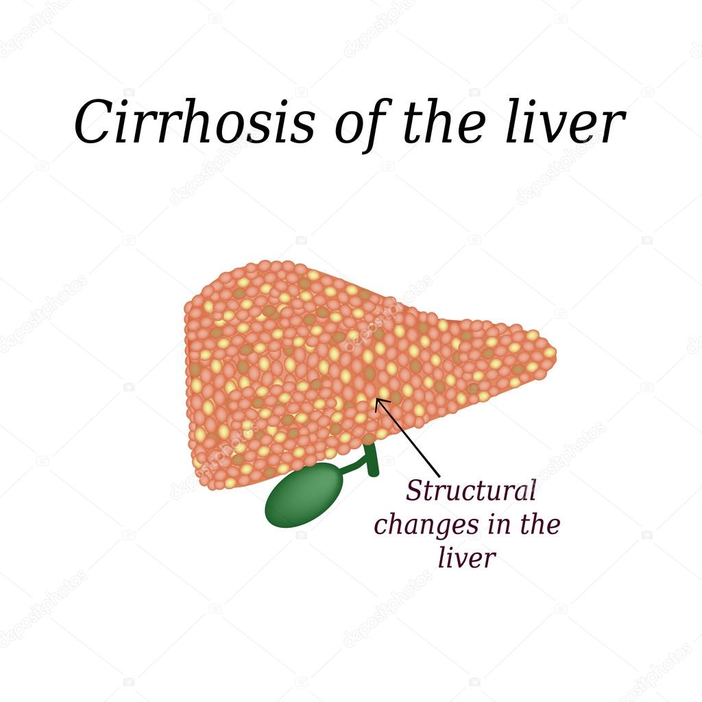 Cirrhosis of the liver. Vector illustration on isolated background