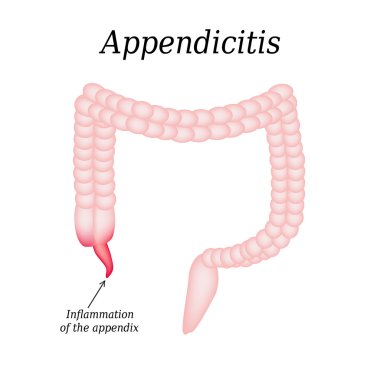 Appendicitis. Inflammation of the appendix. Colon. The illustration on isolated background clipart