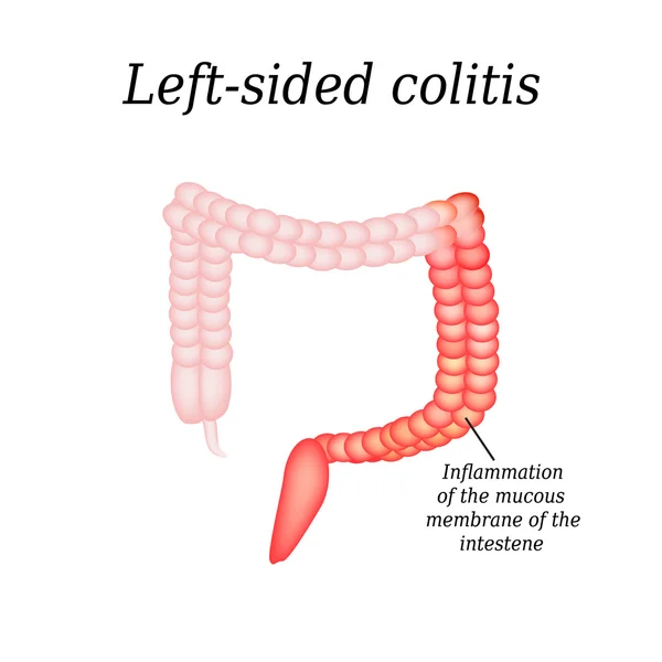 大腸部門の炎症。孤立した背景のベクトル図 — ストックベクタ
