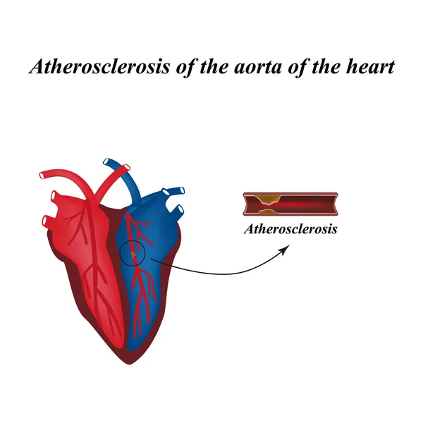 Atherosclerosis of the arteries of the heart. Infographics. Vector illustration — Stock Vector