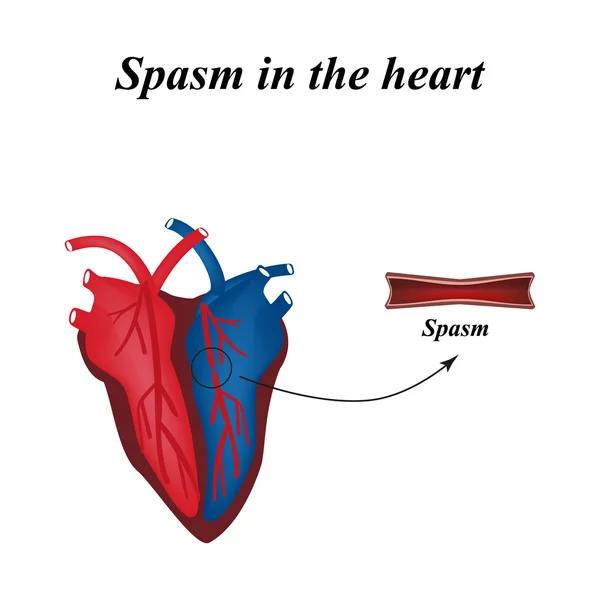 Kalp damar spazmı. Infographics. Vektör çizim — Stok Vektör