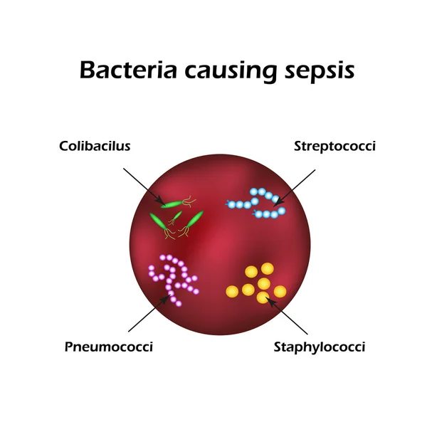 Sepsis. Blutvergiftung. e. coli. Streptokokken. Pneumokokken. Staphylokokken. Infografiken. Vektorillustration — Stockvektor
