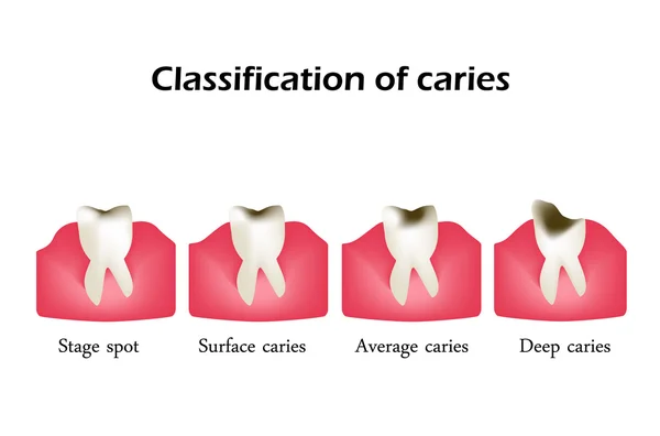 Tipos de caries dental. Infografías. Ilustración vectorial sobre fondo aislado — Vector de stock