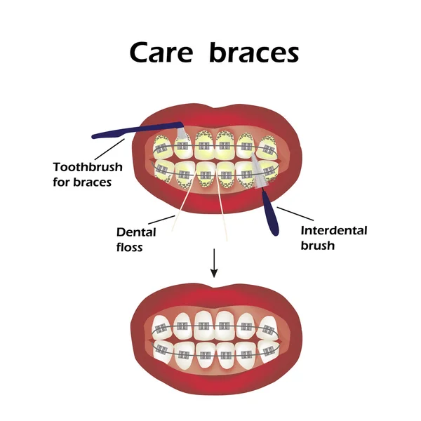 Cuidado con los aparatos. Cepillo dental interdental. Hilo dental. Infografías. Ilustración vectorial sobre fondo aislado — Archivo Imágenes Vectoriales