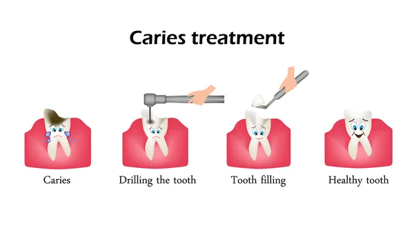 Tratamiento de la caries. Perforando un diente. Sellado del diente. Infografías. Ilustración vectorial en estilo de dibujos animados sobre fondo aislado — Archivo Imágenes Vectoriales