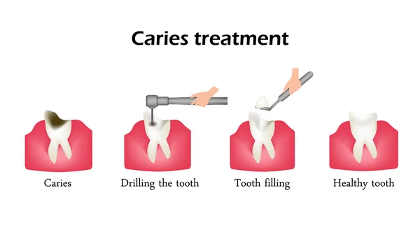 Treatment of caries. Drilling a tooth. Sealing of the tooth. Infographics. Vector illustration on isolated background — Stock Vector